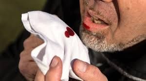 Pasien yang Ditolak RSUD STS Tebo Kemarin, Mulutnya Mengeluarkan Darah