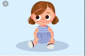 Kasus Campak Tembus 300, Dinkes Jambi Siaga Penuh